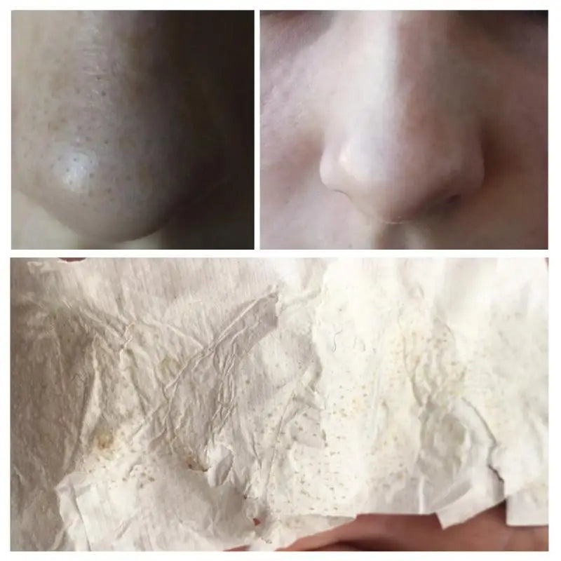 Nose Pore Strips Blackhead Cream